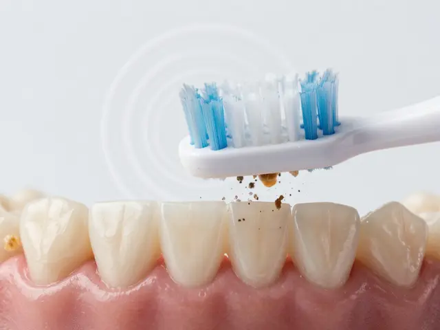 Jak sonický kartáček efektivně odstraňuje zubní kámen