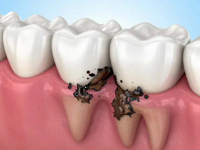 Jak zubní kámen pod dásní ničí vaše zdraví a jak ho odstranit