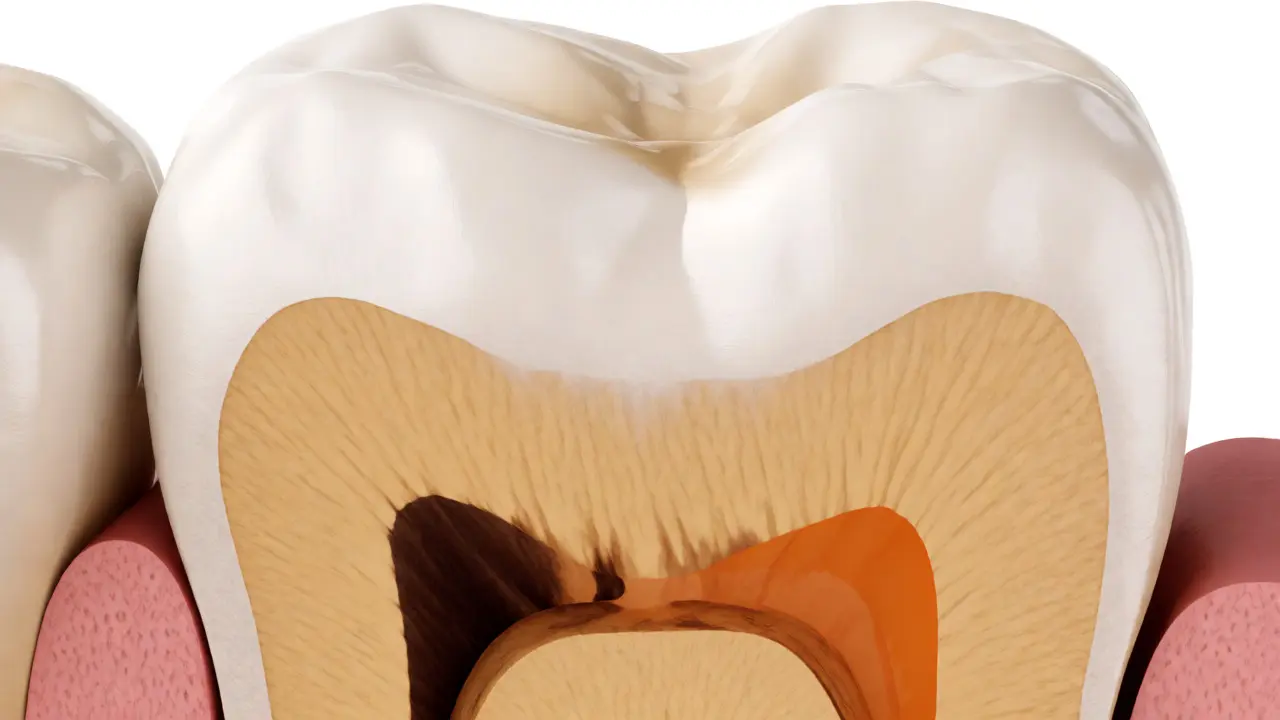Anatomický řez zubem ukazující kaz v dentinu pod neporušenou sklovinou